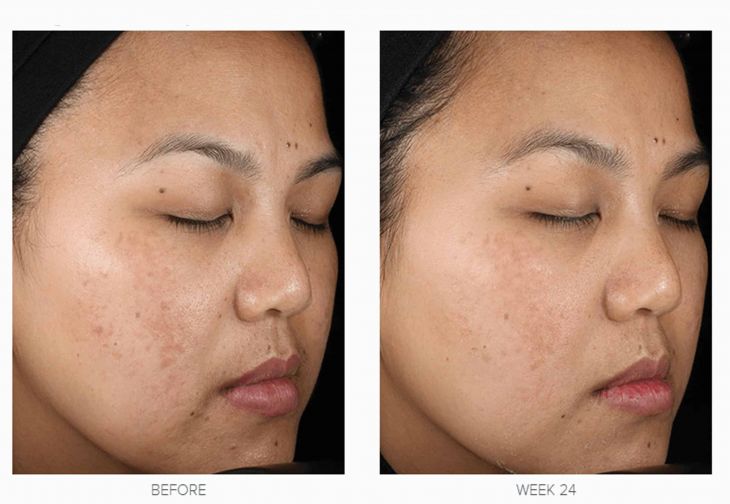 Melasma and Pigmentation Treatment before and after