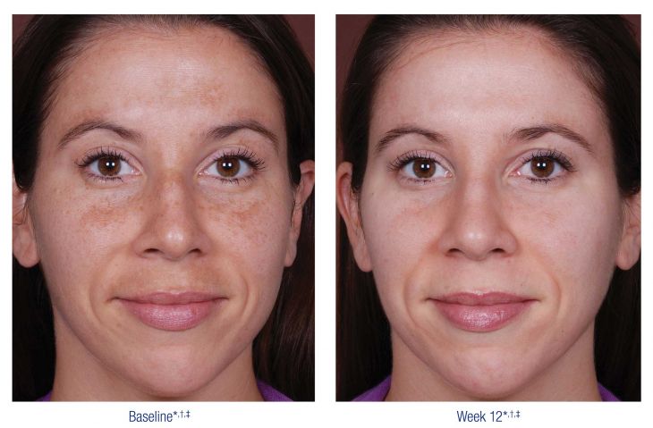 Nu Derm Before and After