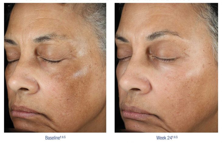 Nu Derm Before and After