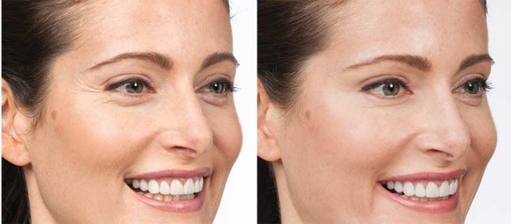 Botox before and after treatment