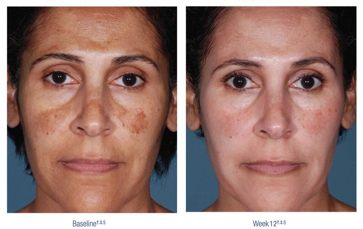 Nu Derm Before and After