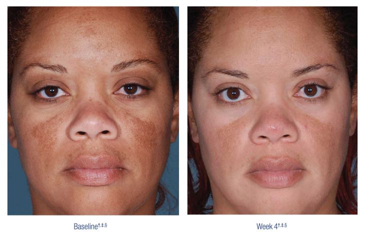 Nu Derm Before and After