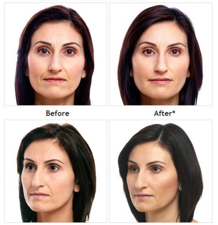 Juvéderm before and after treatment