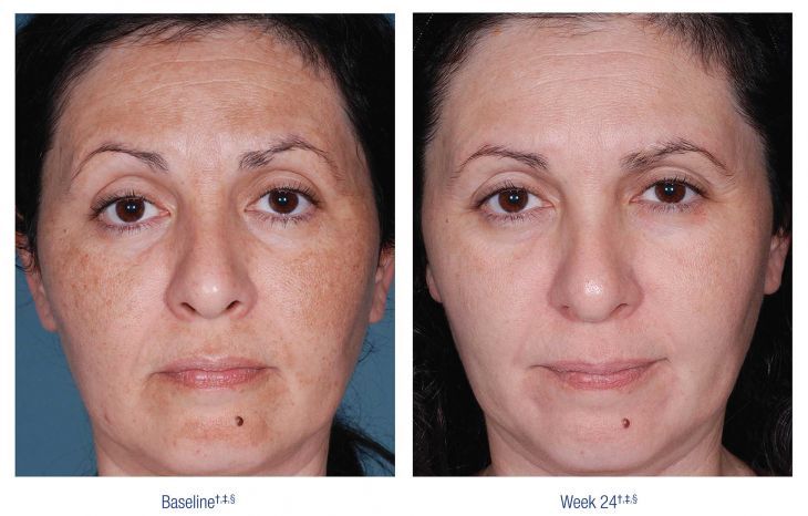 Nu Derm Before and After